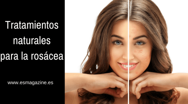 tratamientos naturales rosacea